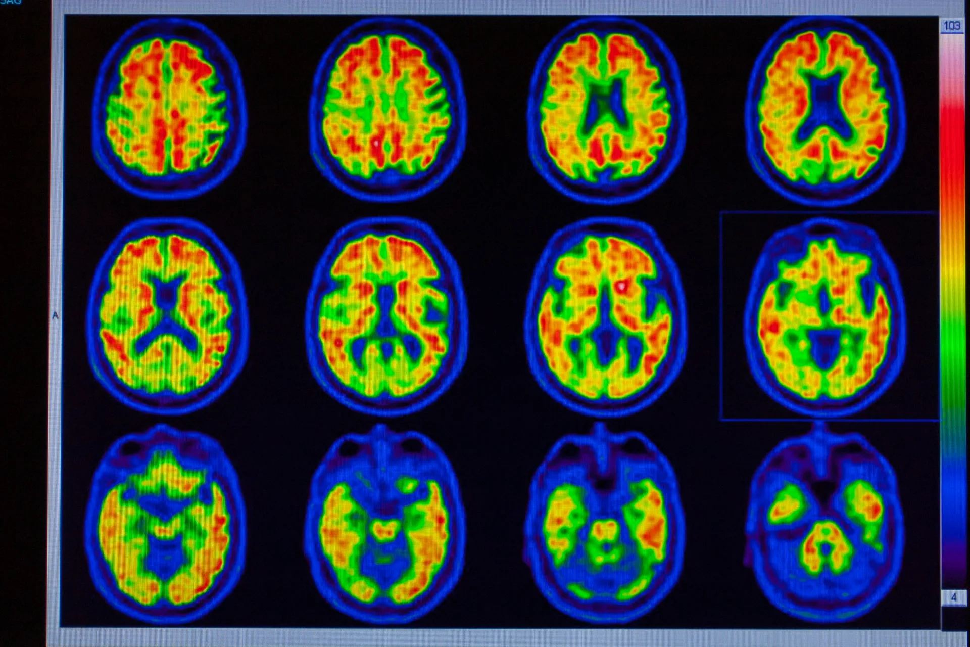 PET brain scans showing metabolic activity across 12 tumor slices